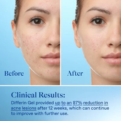 Differin Acne Retinoid Face and Body Treatment Gel Adapalene 0.1% 45g - Imperfect Box - Image 7