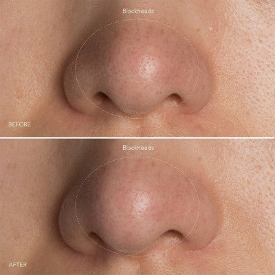 FOREO KIWI Skincare Tool - New - Image 6