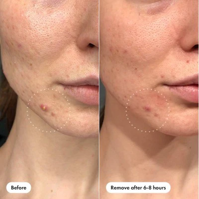 Hero Cosmetics Mighty Patch Invisible Acne Pimple Patches 39ct - New - Image 4