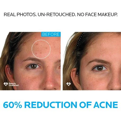 La Roche Posay Effaclar Dermatological Acne Treatment 3-Step System Kit Medicated Gel Cleanser 7.5 fl oz - Imperfect Box - Image 3