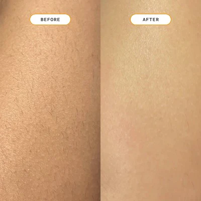 Nood Ingrown Hair Treatment The Eraser - Imperfect Box - Image 6
