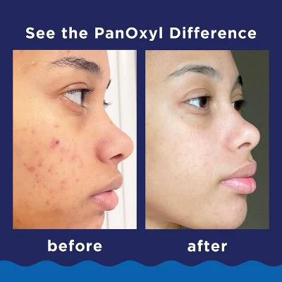 PanOxyl 10% Benzoyl Peroxide Acne Foaming Wash 5.5oz - Imperfect Box - Image 6