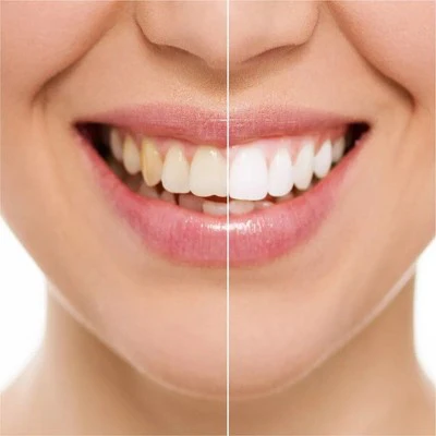 Rembrandt Deeply White + Peroxide Whitening Toothpaste with Fluoride 3.5oz/2pk - New - Image 4