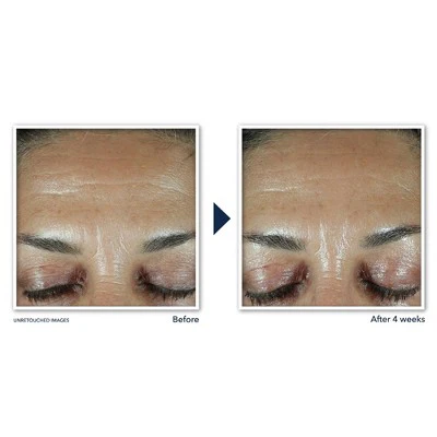 RoC Retinol Correxion Deep Wrinkle Filler 1 fl oz - New - Image 3