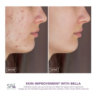 Spa Sciences BELLA 3-in-1 Diamond Tip Microdermabrasion System - New - Image 6