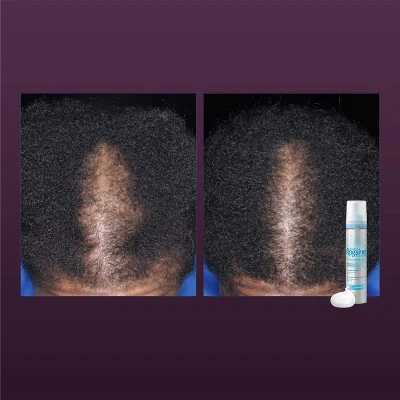 Women's Rogaine 5% Minoxidil Foam for Hair Thinning and Loss, Topical Treatment for Hair Regrowth 2.11oz - New - Image 14